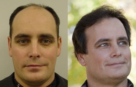 Bobby Petty before and after pictures