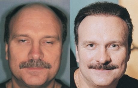 Phil Barfoot before and after pictures