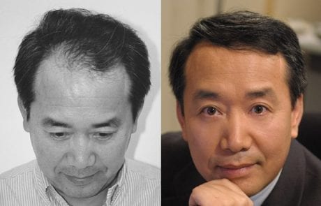 Robert Zhao before and after pictures