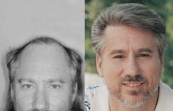 Bill Harris before and after pictures