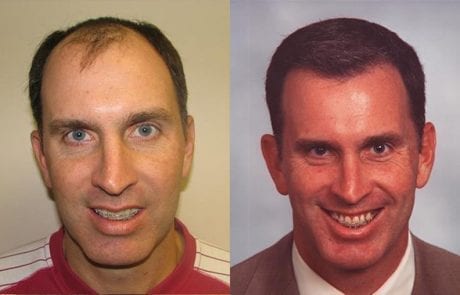 Todd Holzer before and after pictures