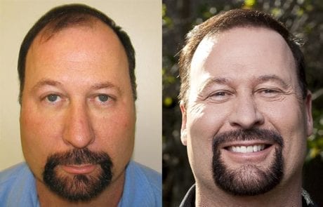 Bruce Jacobs before and after pictures
