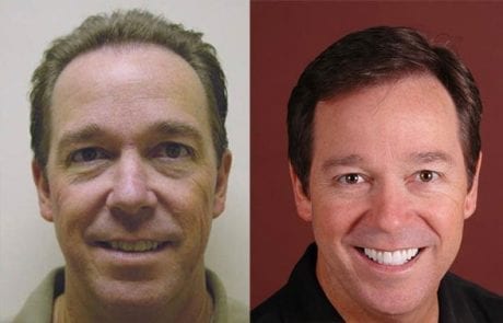 Bob Norton before and after pictures