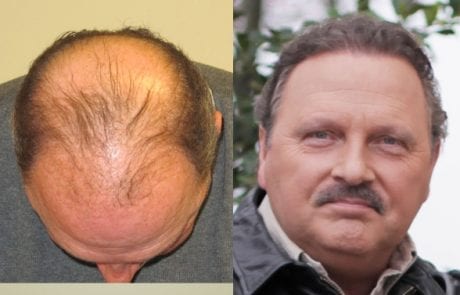 Tony Taylor before and after pictures