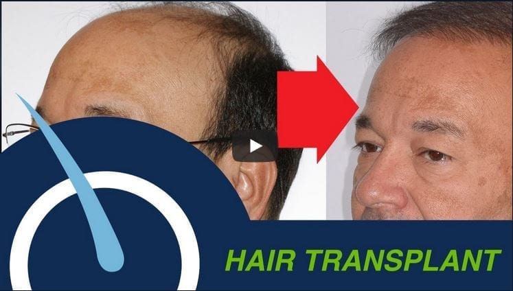 Hair Transplant Youtube video thumbnail