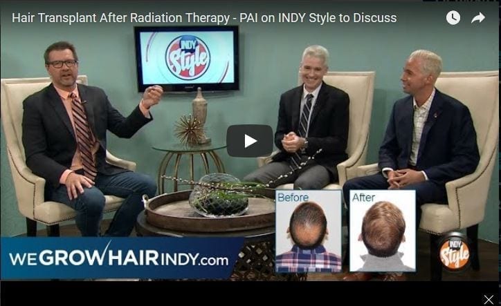 Hair Transplant After Radiation Therapy Youtube video thumbnail